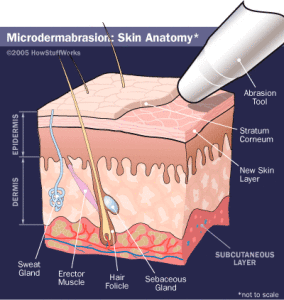microdermabrasion-2